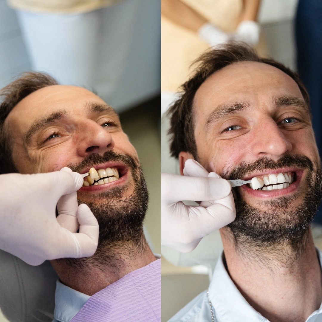 Before in after beljenje zob
